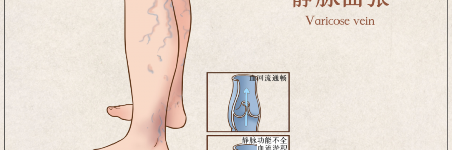 告別“蚯蚓腿”，靜脈曲張怎么調？